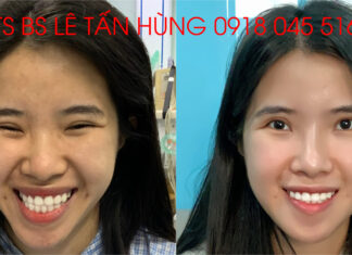 Chỉnh hàm móm – TS BS Lê Tấn Hùng
