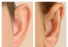 Chỉnh hình tai vểnh – TS BS Lê Tấn Hùng