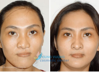 Chỉnh hình xương hàm mặt, xương mũi cho bệnh nhân khe hở môi, vòm miệng – TS BS Lê Tấn Hùng