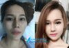 Hình ảnh bệnh nhân trước và sau khi phẫu thuật hạ gò má, gọi hàm V-line