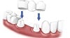 Bọc răng sứ thẩm mỹ – TS BS Lê Tấn Hùng