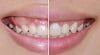 Phương pháp điều trị cười hở lợi – TS BS Lê Tấn Hùng