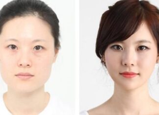 Xinh xinh cằm mới – TS BS Lê Tấn Hùng