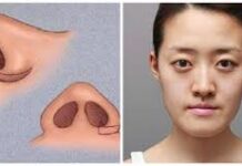 Thu gọn cánh mũi – TS BS Lê Tấn Hùng