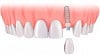 Cấy ghép implant thay thế răng đã mất như răng thật – TS BS Lê Tấn Hùng