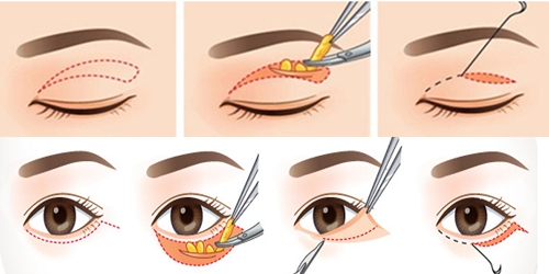 Lấy mỡ mí mắt