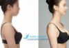 Hình ảnh bệnh nhân trước và sau khi phẫu thuật nâng ngực