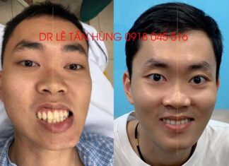 Phẫu thuật khuôn mặt bất cân xứng – TS BS Lê Tấn Hùng
