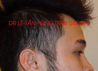 Phẫu thuật trượt cằm – TS BS Lê Tấn Hùng