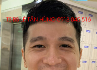 Điều trị nụ cười không thấy răng bằng phẫu thuật kéo dài xương hàm trên – TS BS Lê Tấn Hùng