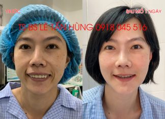 Cải thiện thẩm mỹ khuôn mặt, môi, miệng và nụ cười ngay sau 1 ngày được phẫu thuật chỉnh hàm – TS BS Lê Tấn Hùng