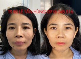 Thoát khỏi mặc cảm “gò má cao, mặt vuông, miệng nhọn” với 1 lần phẫu thuật duy nhất – TS BS Lê Tấn Hùng