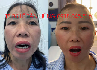 Phẫu thuật tái tạo khớp thái dương hàm 2 bên, kết hợp với chuyển vạt cơ thái dương chèn vào giữa lồi cầu xương hàm dưới và xương thái dương nhằm giúp xương hàm dưới vận động dễ dàng hơn và tránh tái phát – TS BS Lê Tấn Hùng